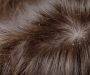 Preventing and Managing Dandruff