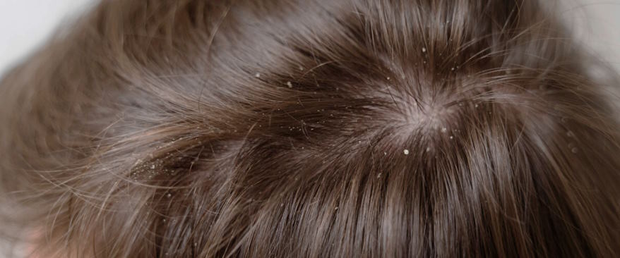 dandruff symptoms